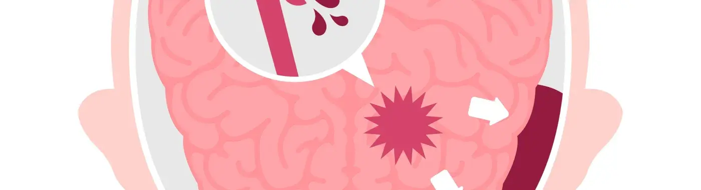 Subarachnoid Hemorrhage