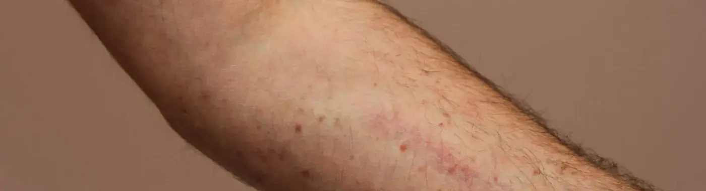 Systemic Mastocytosis – Symptoms, Causes, Complications and Treatment