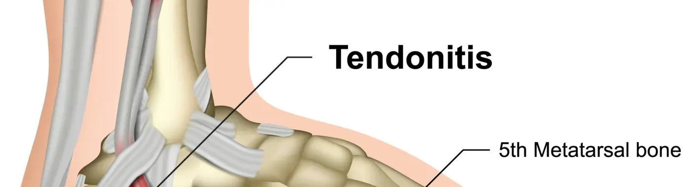 Tendinitis