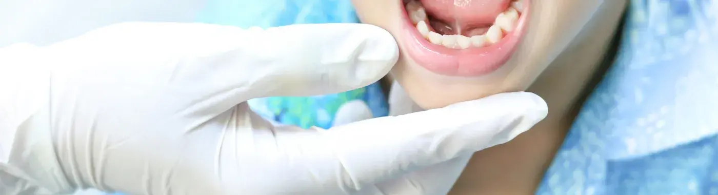 Tongue-tie (Ankyloglossia)