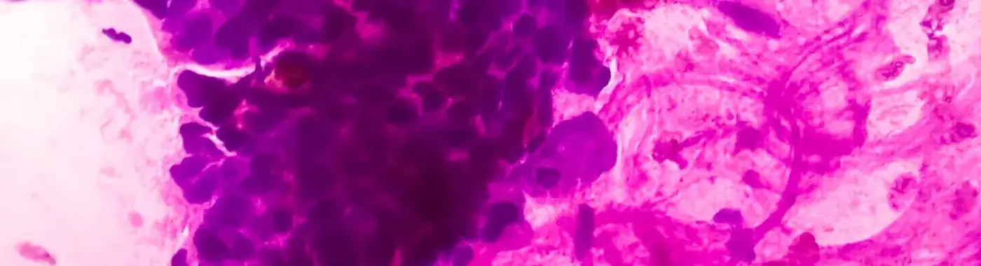 Undifferentiated Pleomorphic Sarcoma: Causes, Symptoms and Treatment