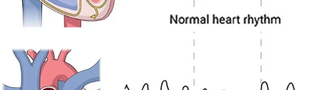 Ventricular Tachycardia- Causes, Symptoms and Treatment