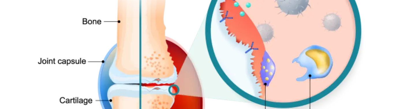 Arthritis – Causes, Symptoms and Treatment