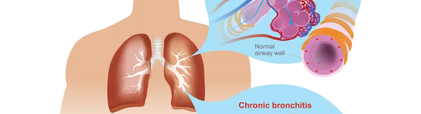 Bronchitis Symptoms, Causes, Diagnosis and Treatment