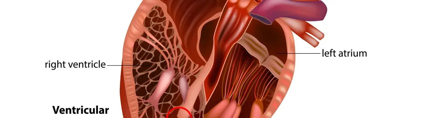 Ventricular Septal Defect (VSD)