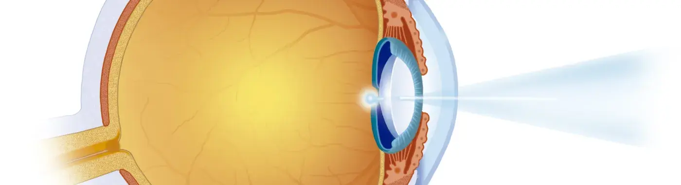 Wet Macular Degeneration