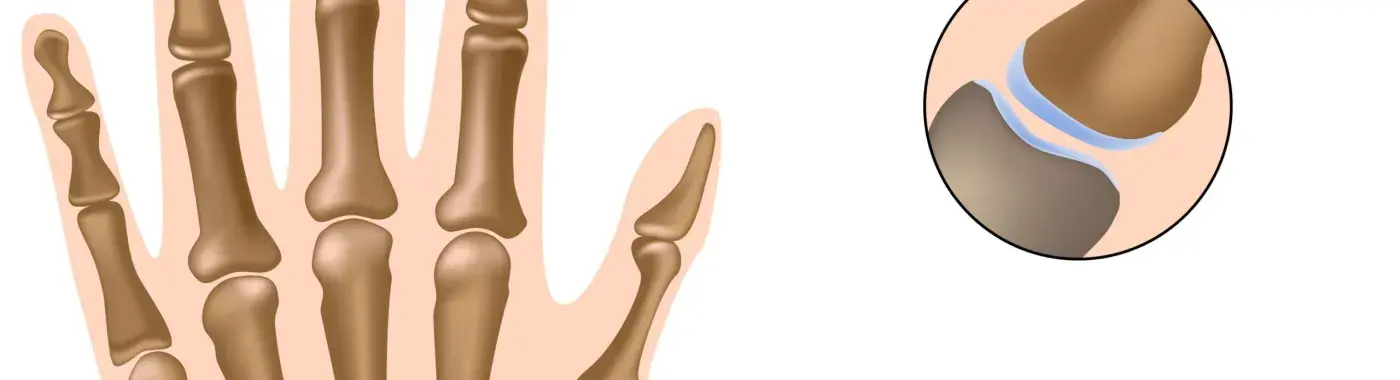 Thumb Arthritis – Causes, Symptoms and Treatment