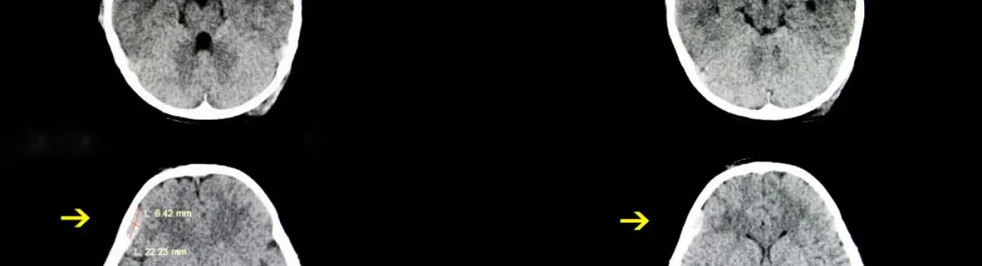 Subdural Hematoma: Types, Symptoms, Causes, Treatment