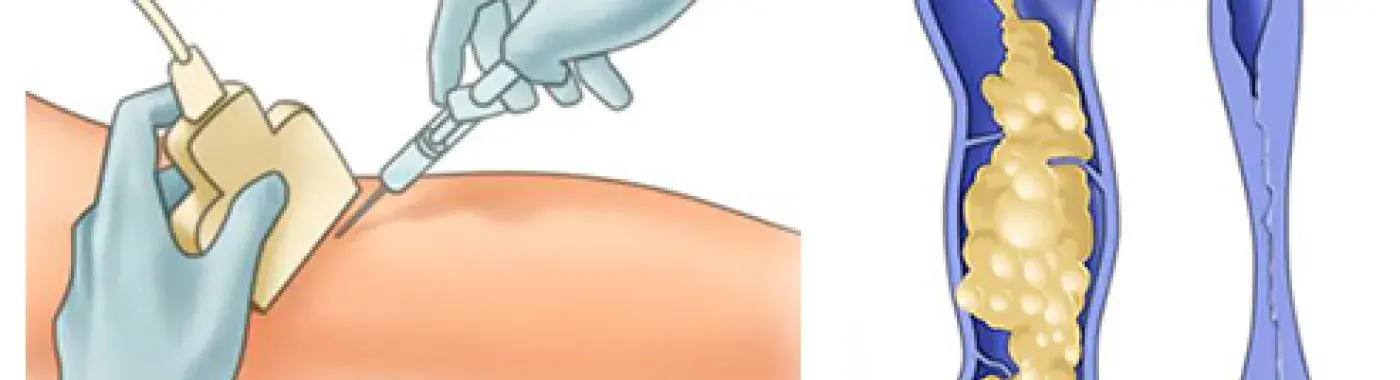 How can Varicose veins be treated