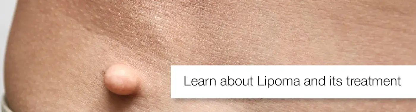 Lipoma