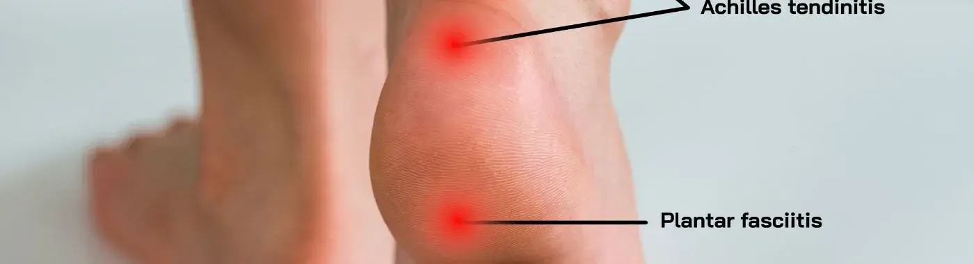 Achilles Tendon Rupture - Causes, Symptoms, Diagnosis, Treatment, and Prevention