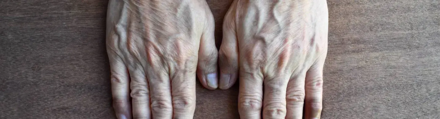 Acrocyanosis - Causes, Symptoms, Diagnosis, Treatment, and Prevention