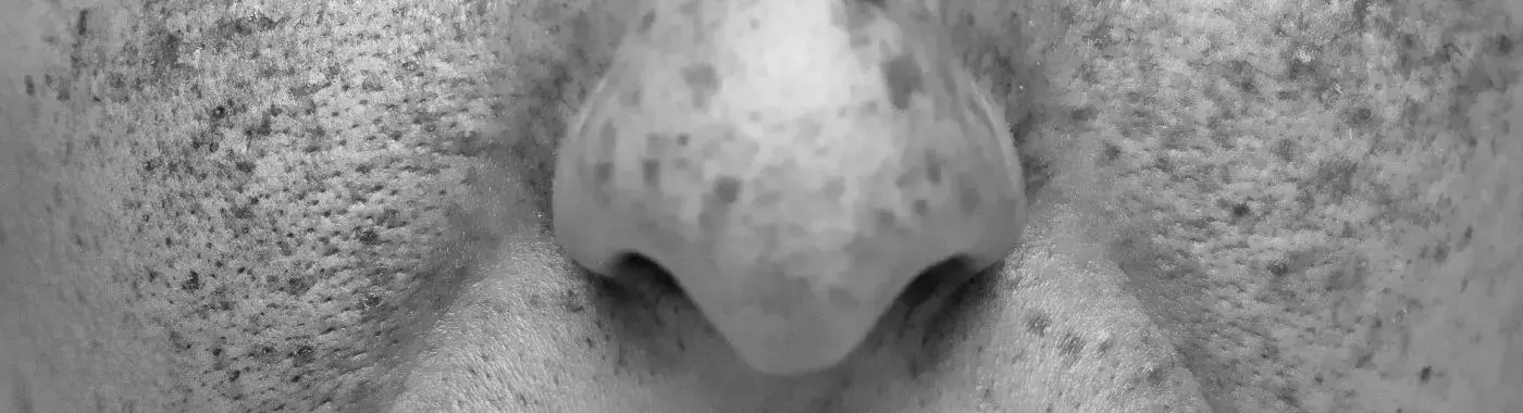 Actinic Cheilitis - Causes, Symptoms, Diagnosis, Treatment, and Prevention