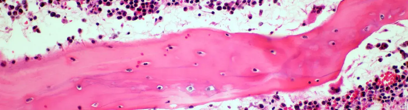 Adenoid Cystic Carcinoma - Causes, Symptoms, Diagnosis, Treatment, and Prevention