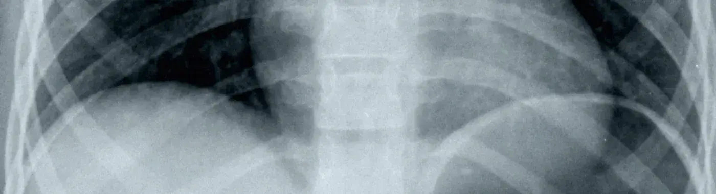 Aerophagia - Causes, Symptoms, Diagnosis, Treatment, and Prevention