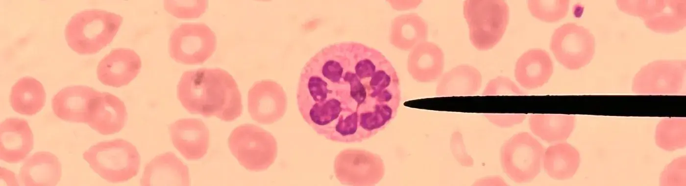 Agranulocytosis - Causes, Symptoms, Diagnosis, Treatment, and Prevention