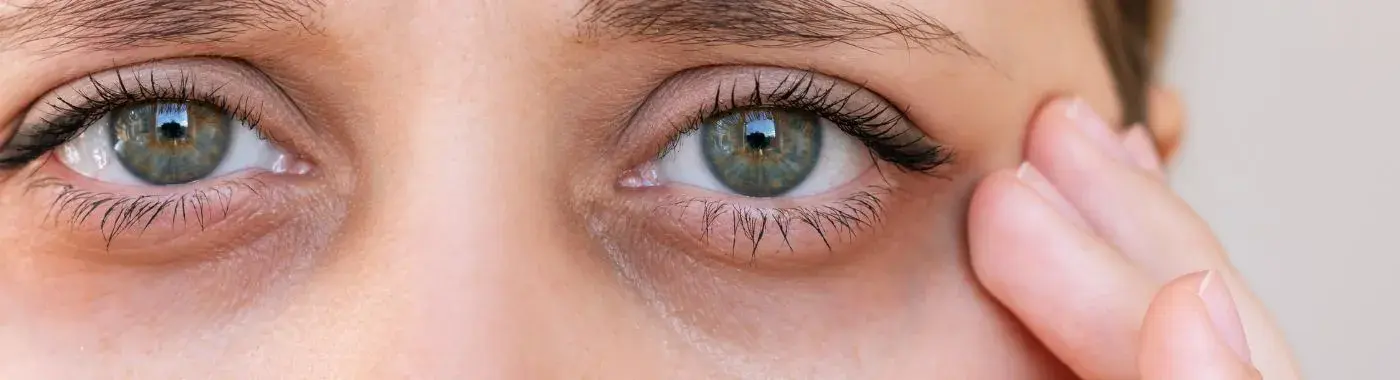 Allergic Shiners - Causes, Symptoms, Diagnosis, Treatment, and Prevention