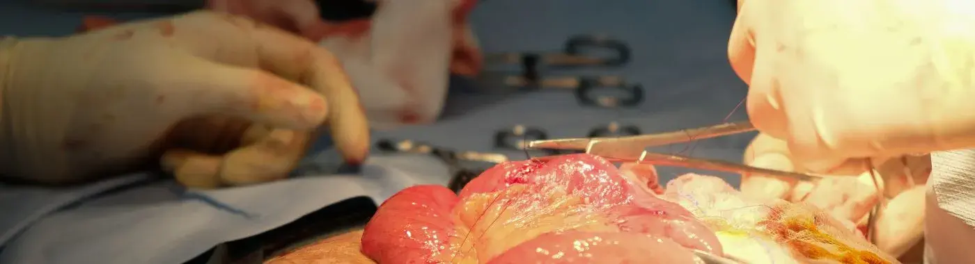 Anastomotic Leak - Causes, Symptoms, Diagnosis, Treatment, and Prevention