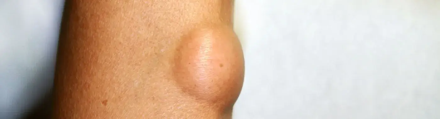 Angiolipoma - Causes, Symptoms, Diagnosis, Treatment, and Prevention