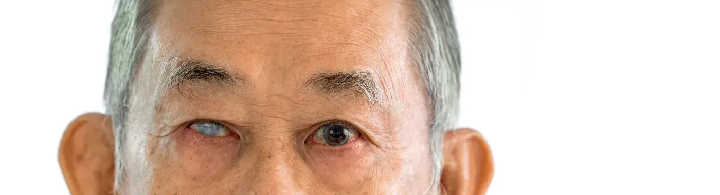 Angle Closure Glaucoma - Causes, Symptoms, Diagnosis, Treatment, and Prevention