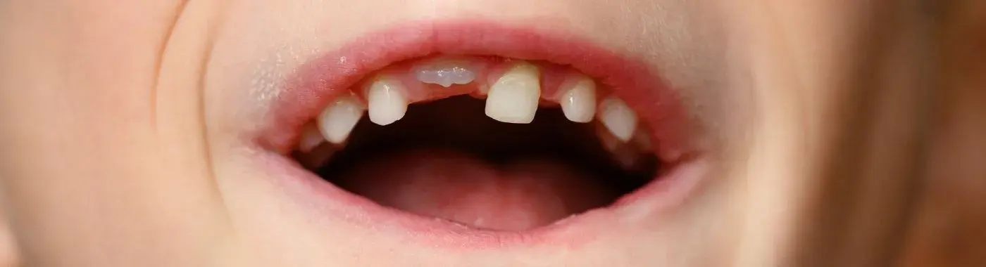 Anodontia - Causes, Symptoms, Diagnosis, Treatment, and Prevention