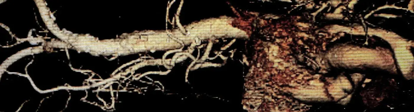 Aortic Dissection - Causes, Symptoms, Diagnosis, Treatment, and Prevention