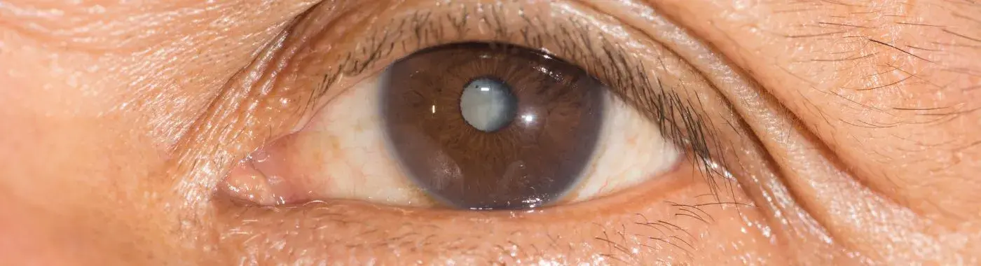 Aphakia - Causes, Symptoms, Diagnosis, Treatment, and Prevention