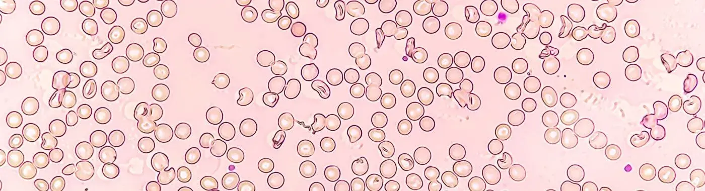 Aplastic Crisis - Causes, Symptoms, Diagnosis, Treatment, and Prevention