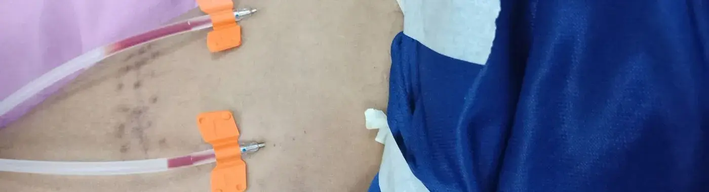 Arteriovenous Fistula - Causes, Symptoms, Diagnosis, Treatment, and Prevention