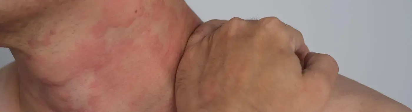 Arthus Reaction - Causes, Symptoms, Diagnosis, Treatment, and Prevention