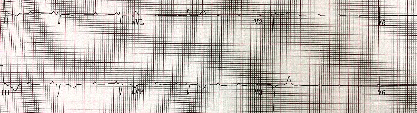 Atrioventricular Canal Defect - Causes, Symptoms, Diagnosis, Treatment, and Prevention