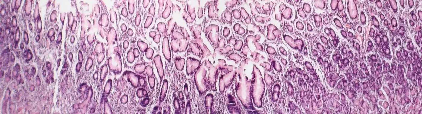 Atrophic Gastritis - Causes, Symptoms, Diagnosis, Treatment, and Prevention