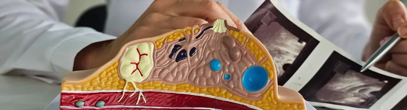 Atypical Ductal Hyperplasia - Causes, Symptoms, Diagnosis, Treatment, and Prevention