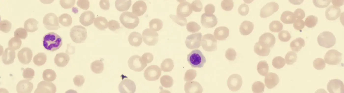 Autoimmune Hemolytic Anemia - Causes, Symptoms, Diagnosis, Treatment, and Prevention