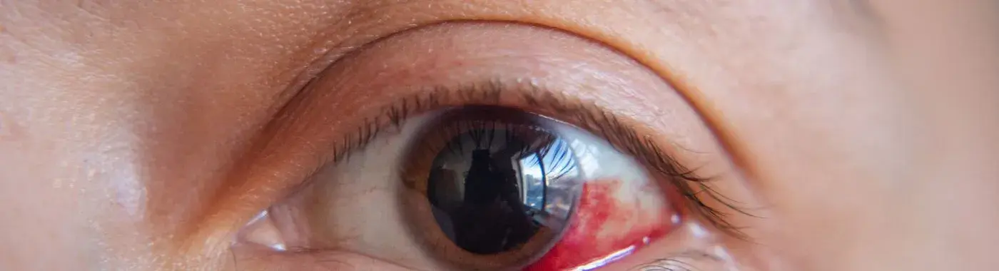 Axenfeld Rieger Syndrome - Causes, Symptoms, Diagnosis, Treatment, and Prevention