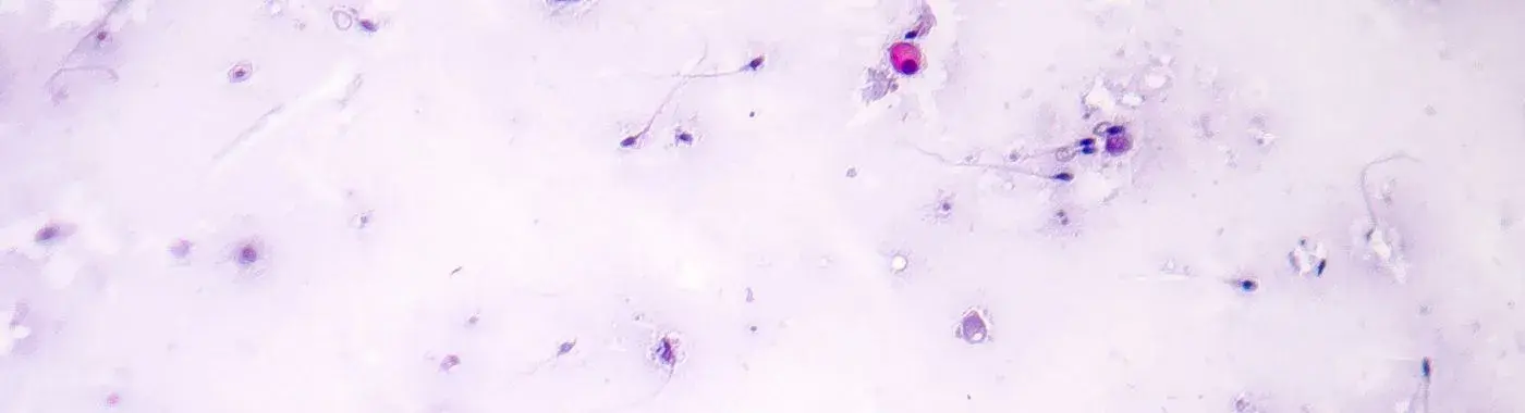 Azoospermia - Causes, Symptoms, Diagnosis, Treatment, and Prevention