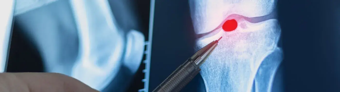 Bakers Cyst - Causes, Symptoms, Diagnosis, Treatment, and Prevention