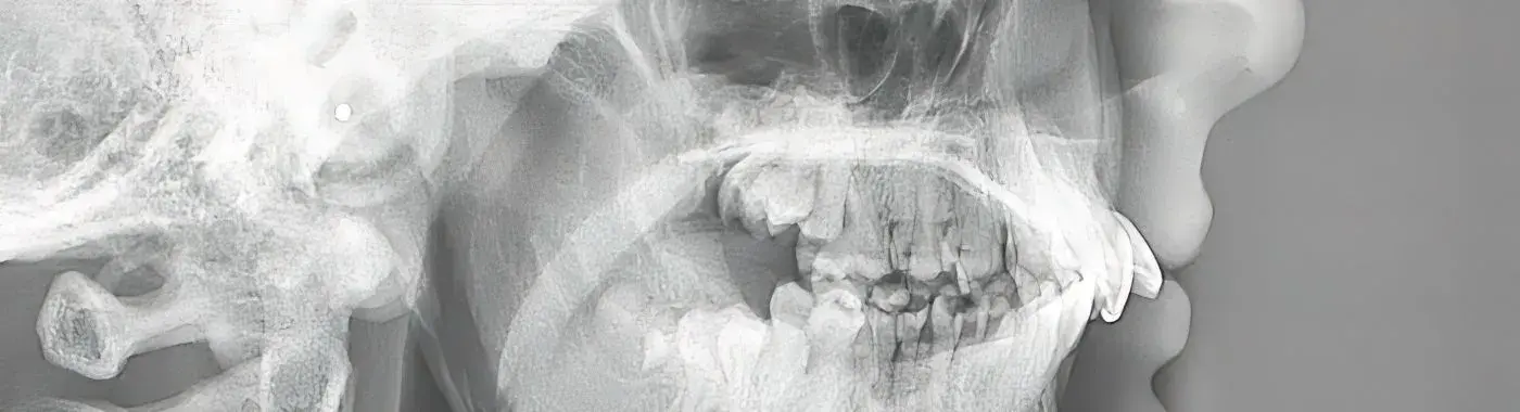 Binder Syndrome - Causes, Symptoms, Diagnosis, Treatment, and Prevention