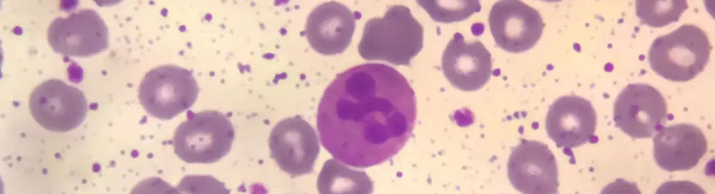 Bone marrow failure syndrome - Causes, Symptoms, Diagnosis, Treatment, and Prevention