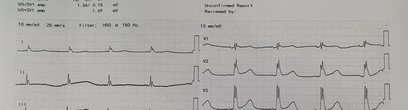 Bradyarrhythmia - Causes, Symptoms, Diagnosis, Treatment, and Prevention