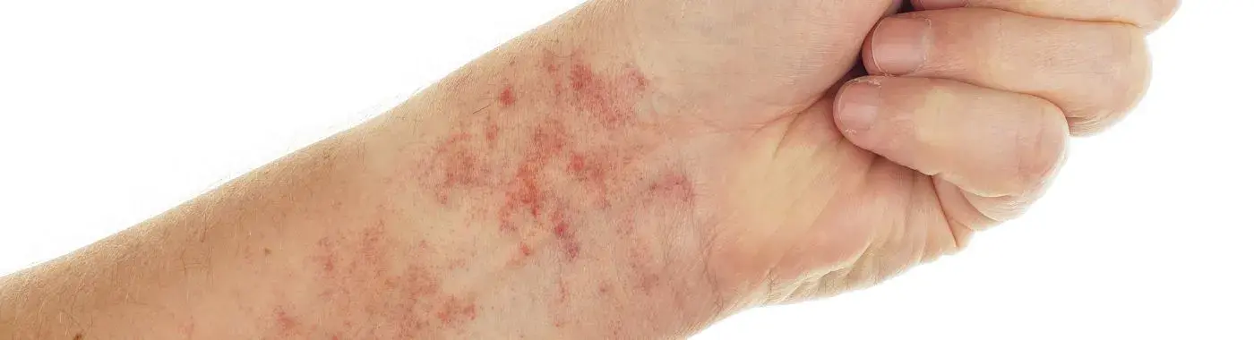 Capillary Leak Syndrome - Causes, Symptoms, Diagnosis, Treatment, and Prevention