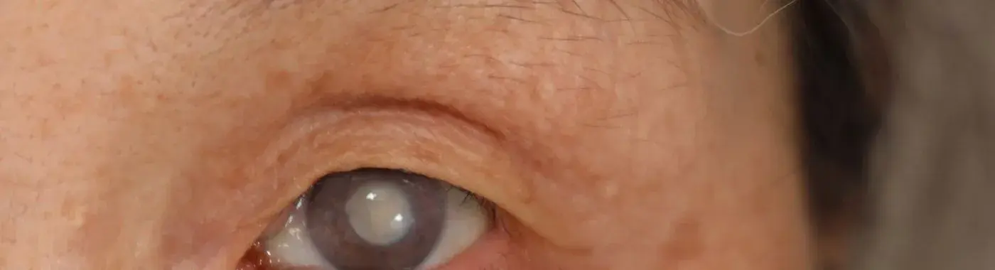 Cataract