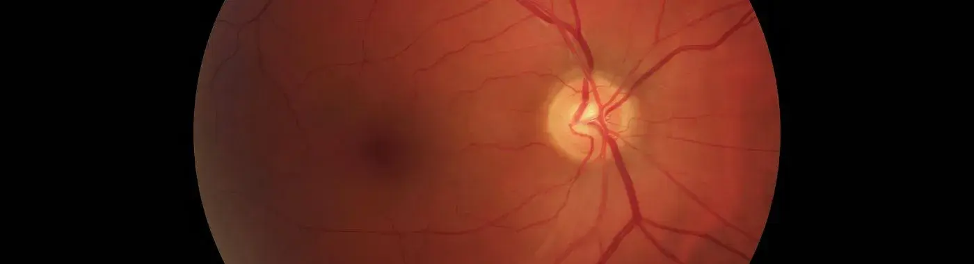 Central Serous Retinopathy - Causes, Symptoms, Diagnosis, Treatment, and Prevention