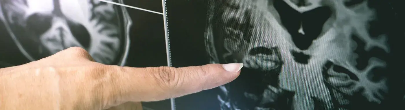 Cerebral Infarction- Causes, Symptoms and Treatment