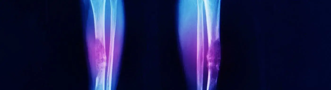 Chondroblastoma - Causes, Symptoms, Diagnosis, Treatment, and Prevention