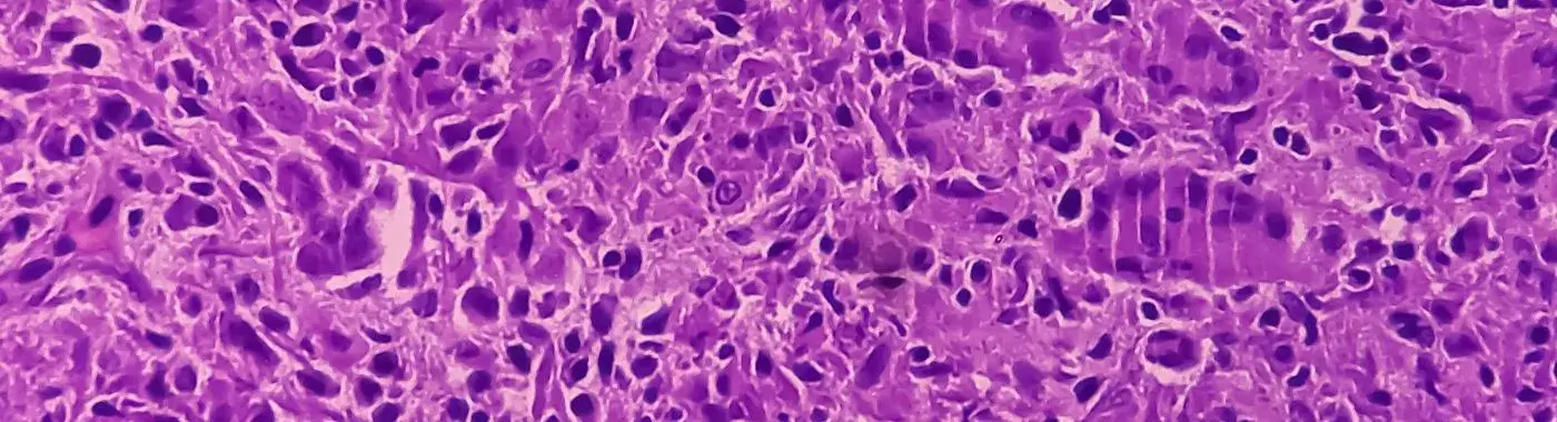 Chronic Granulomatous Disease - Causes, Symptoms, Diagnosis, Treatment, and Prevention