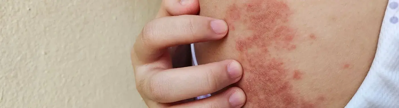 Chronic Hives - Causes, Symptoms, Diagnosis, Treatment, and Prevention