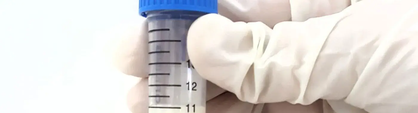 Chyluria - Causes, Symptoms, Diagnosis, Treatment, and Prevention