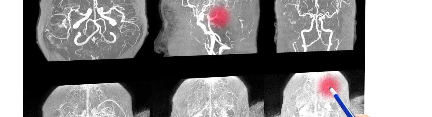 Colpocephaly - Causes, Symptoms, Diagnosis, Treatment, and Prevention