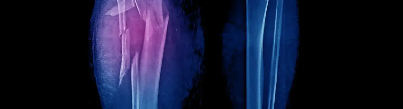 Comminuted Fracture - Causes, Symptoms, Diagnosis, Treatment, and Prevention